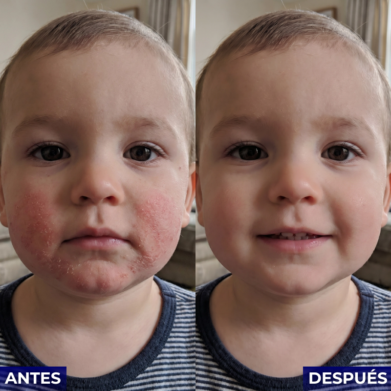 Veltrix™ Crema Intensiva Para Eczema