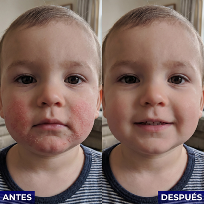 Veltrix™ Crema Intensiva Para Eczema
