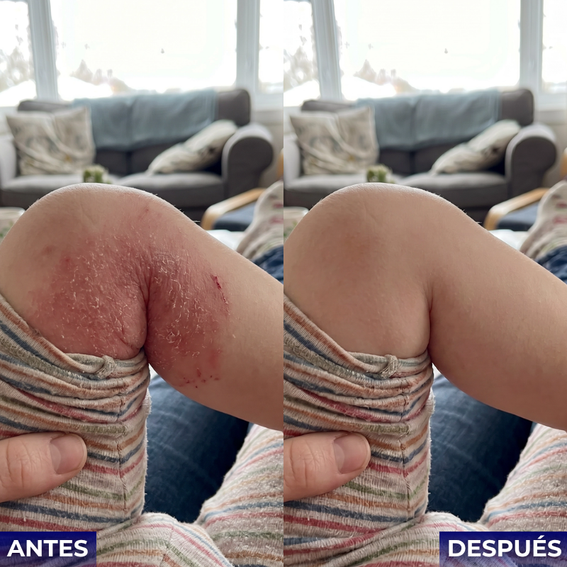 Veltrix™ Crema Intensiva Para Eczema